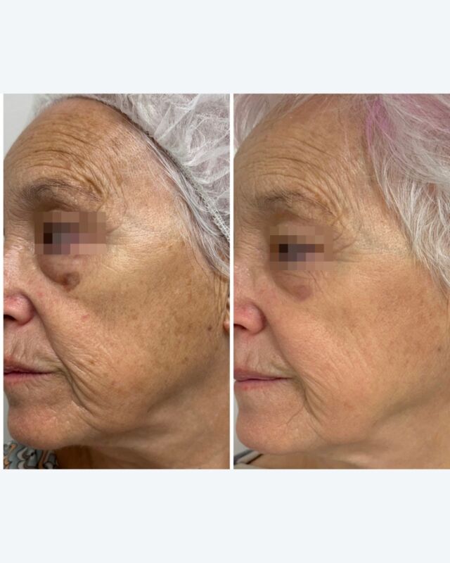 Despídete de las manchas y dale una nueva vida a tu piel. 💫
Antes y después real: Menos manchas, más juventud. 💙 ¡Reserva tu sesión! ✨

#clinicaisturitz #antesydespues #clinicaestetica #laser #lasermanchas #medicinaestetica #beforeandafter #colageno #tratamientofacial #laserfacial