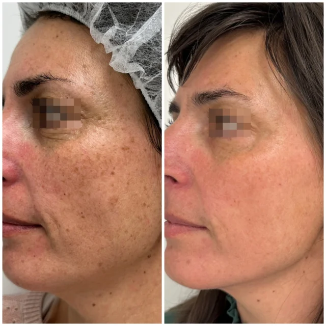El Láser es tu aliado perfecto para conseguir una piel más joven, renovada y libre de imperfecciones. 

🔹 Antes: Presencia de manchas, pigmentación irregular y signos de envejecimiento cutáneo.
🔹 Después: Tono uniforme, piel rejuvenecida y libre de manchas visibles.

Este tratamiento actúa de manera precisa para reducir las imperfecciones cutáneas y devolverle a tu piel su luminosidad natural.
🌿 Recupera la confianza en tu piel.

#clinicaestetica #clinicaisturitz #laser #lasermanchas #antesydespues #medicinaestetica #tratamientofacial #beforeandafter #belleza